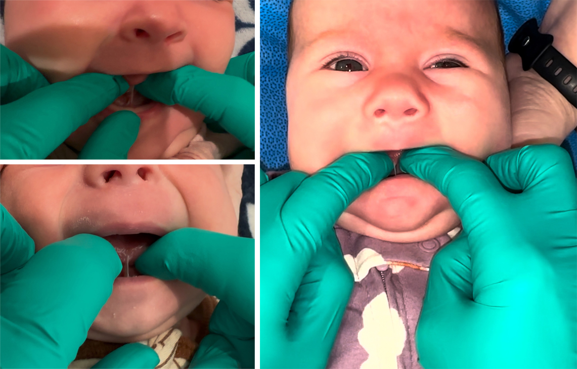 Lingual Frenulectomy Tongue-Tie Revisions)